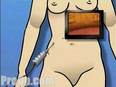 Gastric Adjustable Band Laparoscopic Surgery - Alternatives