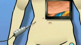 Spleen Removal Laparoscopic Splenectomy  - Alternatives