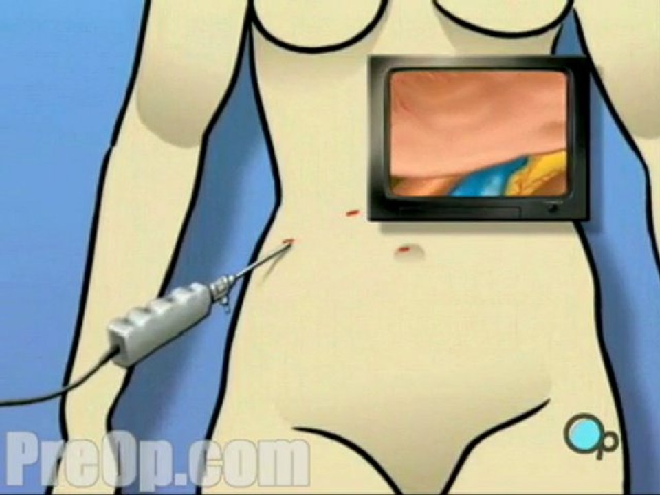 Spleen Removal Laparoscopic Splenectomy  - Alternatives