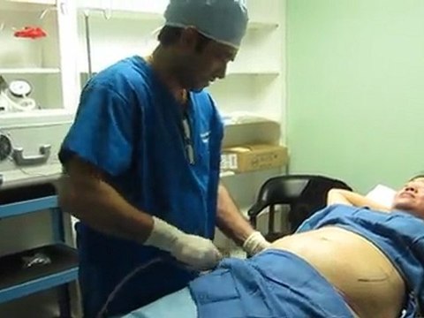 Laser Liposuction-Los Angeles County-Orange County-Riverside County-San Bernardino County-Inland Empire-Anaheim-Fullerton-Rancho Cucamonga-Irvine-Orange-Cerritos-Whittier-Covina-Hacienda Heights-Rowland Heights