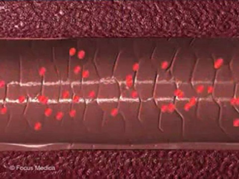 Acyanotic Heart Disease (Animated Pocket Dictionary)