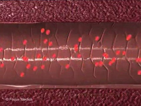 Acyanotic Heart Disease (Animated Pocket Dictionary)