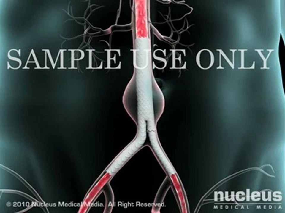 Understanding Abdominal Aortic Aneurysm Disorder