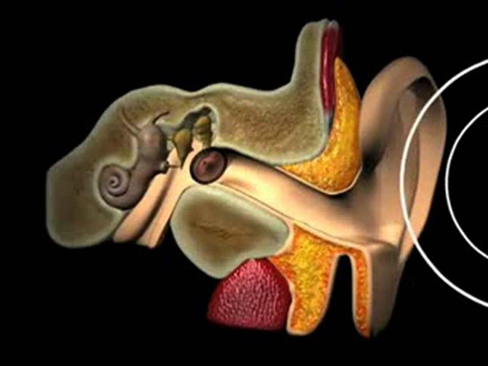 Otitis Media (Understanding Disease_ Infectious Diseases & Oncology)
