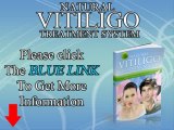 Natural Vitiligo Treatment System Review - How to Cure Vitiligo Fast