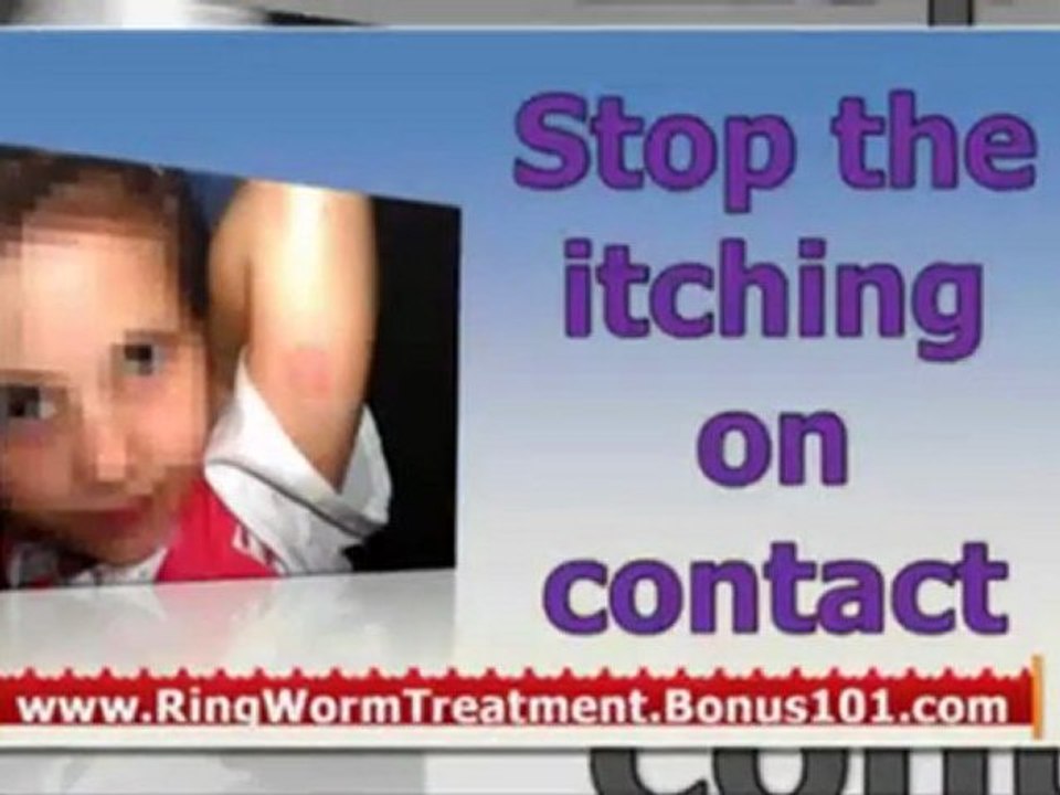 ringworm cures - ringworm remedies - ringworm home treatment