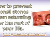tonsil stones removal - remove tonsil stones - get rid of tonsil stones