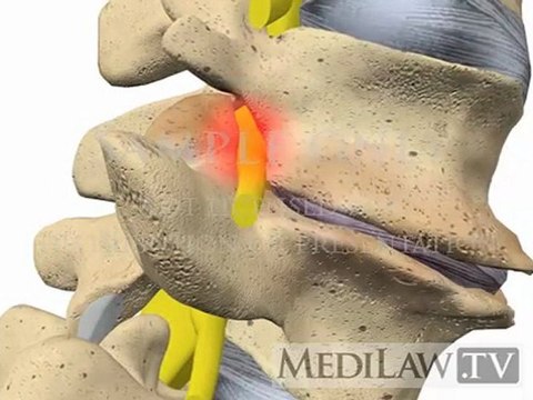 Lumbar Spine Movement Intervertebral Degenerative Disc Disease Osteo-arthritis Spondylosis trial exhibit animations