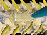 Cervical Spine Surgical Vertebrectomy Corpectomy with cage   plate surgical medical 3D animations