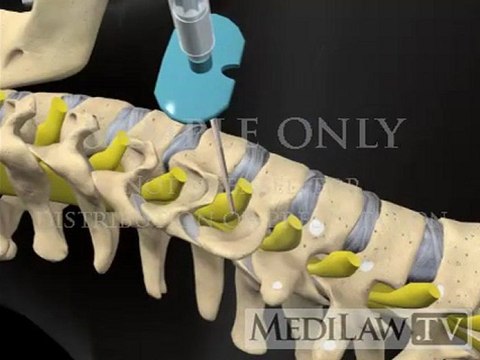 Cervical Spine Selective Nerve Root Block neuro-surgical animations