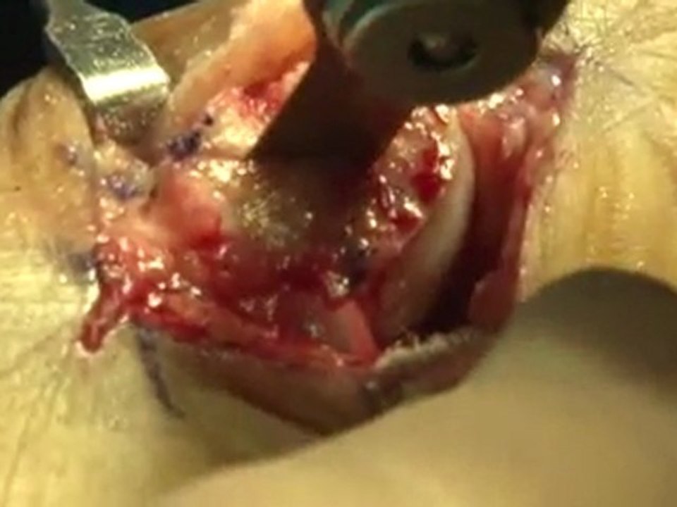 Bunion Surgery in NYC  - Manhattan Podiatrist