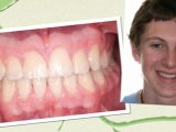 New Smiles with Fort Collins Orthodontist