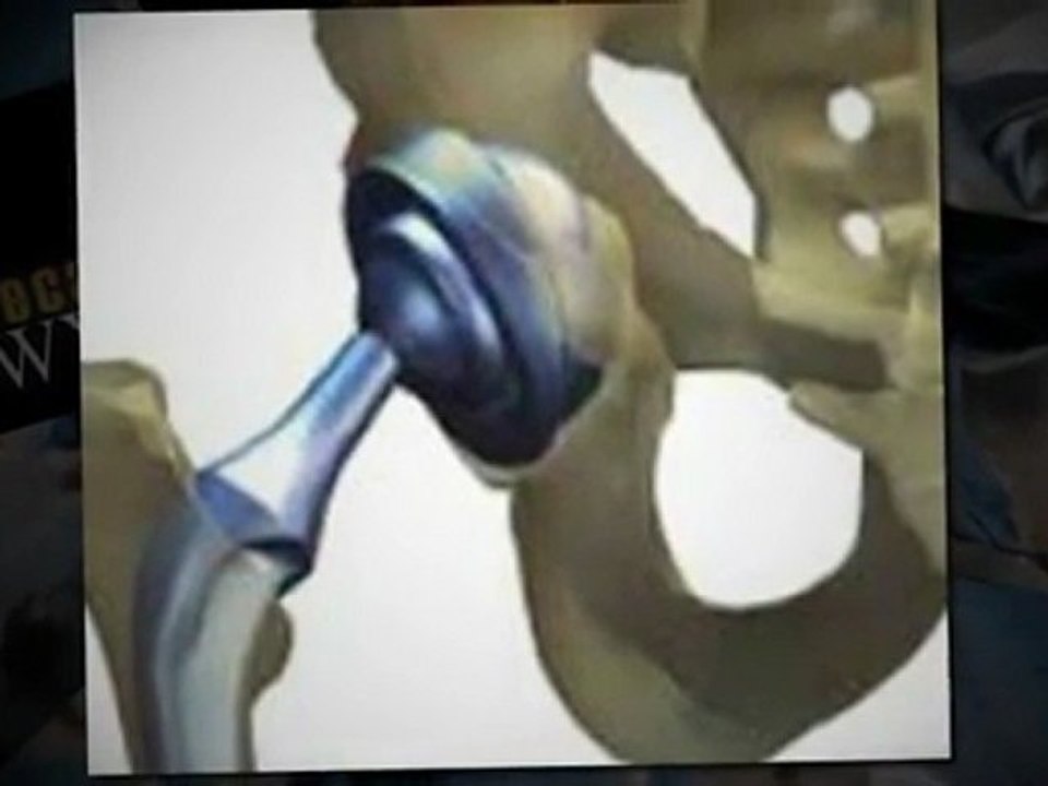 DePuy Hip Recall - The Assistance You Need