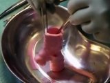 First Successful Transplant of Trachea Made of Stem Cells