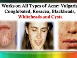 best treatment for acne scars - acne treatments at home
