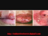 How To Relieve Cold Sores -Tips To Treat Cold Sore - How To Cure Cold Sore Fast