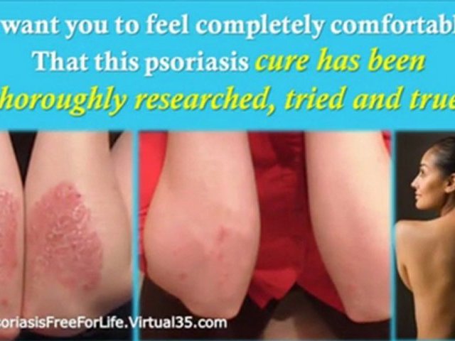 psoriasis scalp treatment – treatment for psoriasis