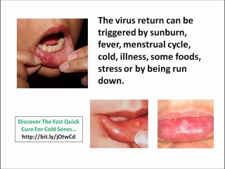 Get Rid of COLD SORES Fast Treatment and Info