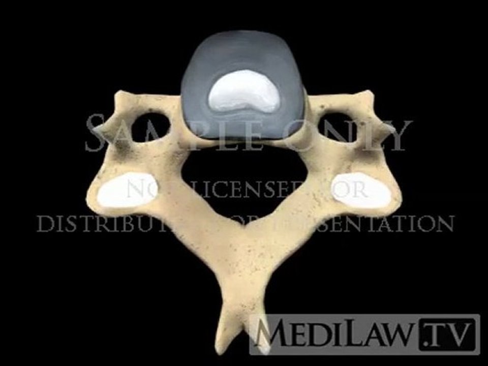 Cervical Spine Medical Imaging Provocative Discography Discogram pain management videos