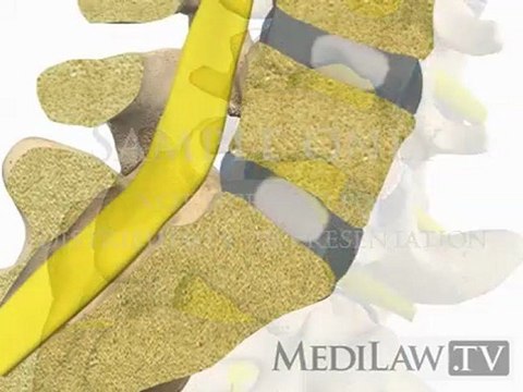 Lumbar Spine Pathology Spondylolisthesis Isthmic High Grade orthopeadic movies