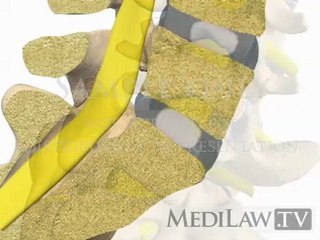 Lumbar Spine Pathology Spondylolisthesis Isthmic High Grade orthopeadic movies