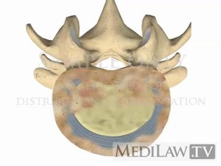 Lumbar Spine Pathology Anylosing Spondylitis Syndesmophytes rheumatologist videos