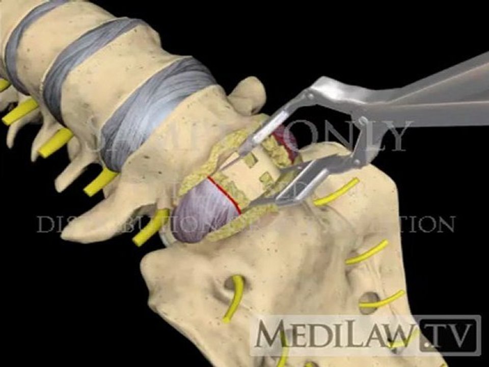 Lumbar Spine Surgery Anterior Interbody Fusion with bone + plate neurosurgical 3D animations