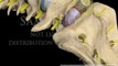 Lumbar Spine Surgery Anterior Interbody Fusion with cage neuro-surgery videos