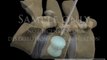 Lumbar Spine Surgery Percutaneous Balloon Vertebroplasty Kyphoplasty medical legal 3D animations