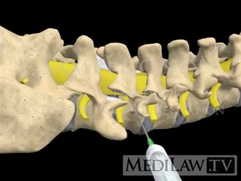 Lumbar Spine Surgery Epidural Injection transforaminal malpractice animations