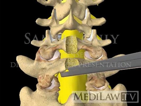 Lumbar Spine Surgery Laminectomy expert witness testimony 3D animations