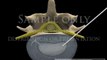 Lumbar Spine Surgery Percutaneous Annuloplasty neuro-surgery movies
