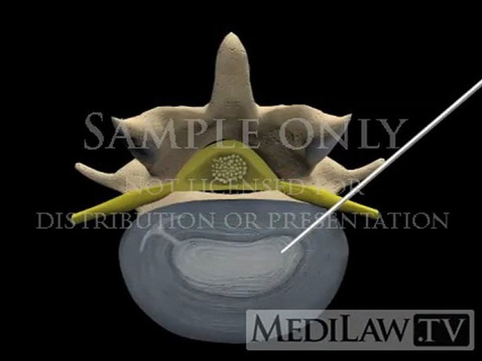 Lumbar Spine Surgery Percutaneous Annuloplasty neuro-surgery movies
