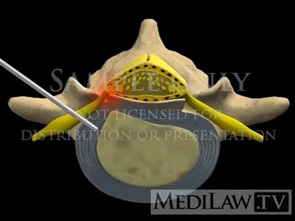 Lumbar Spine Surgery Percutaneous Automated Discectomy operation movies