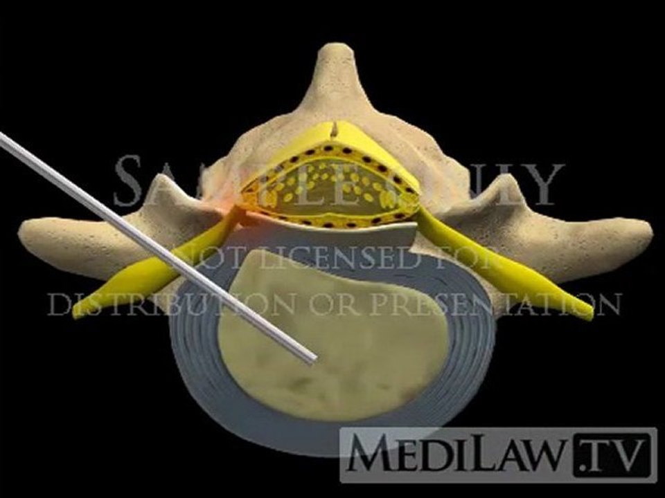 Lumbar Spine Surgery Percutaneous Laser Discectomy personal injury illustrations
