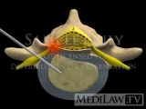 Lumbar Spine Surgery Percutaneous Manual Discectomy surgical 3D animations