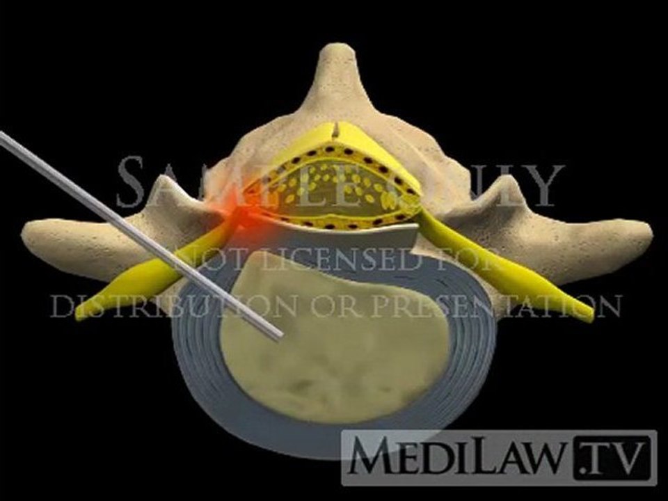 Lumbar Spine Surgery Percutaneous Manual Discectomy surgical 3D animations