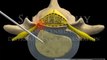 Lumbar Spine Surgery Percutaneous Thermal Discectomy spine education movies