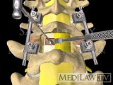 Lumbar Spine Surgery Posterior Interbody Vertebral Fusion with bone surgeon 3D animations