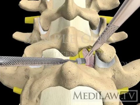 Lumbar Spine Surgery Posterior Micro-discectomy Discectomy neurosurgeon 3D animations