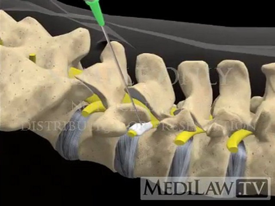 Lumbar Spine Surgery Selective Nerve Root Block Injection neurosurgery movies