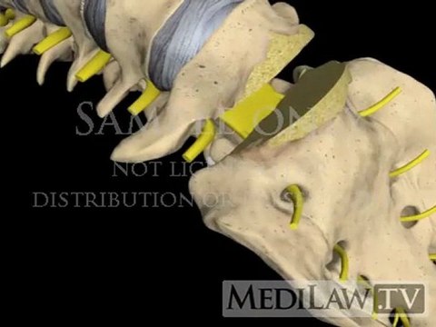 Lumbar Spine Surgery Total Disc Replacement Arthroplasty neurosurgery videos