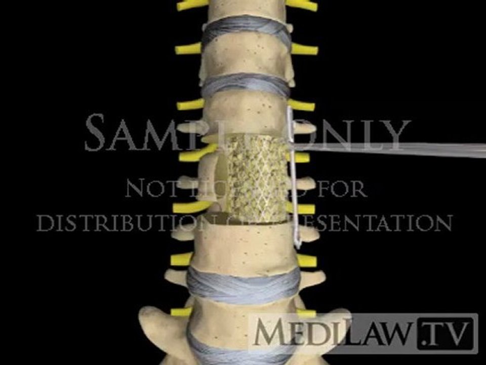 Lumbar Spine Surgery Vertebrectomy Corpectomy with cage + plate medicolegal exhibit 3D animations