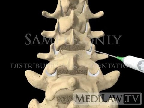 Lumbar Spine Surgery Zygoapophysial Facet Joint Injection pain management 3D movies