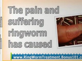 how to get rid of ringworms - ringworm on the scalp - treating ringworm in humans