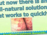 how to get rid of ringworm - home remedies for ringworm - ringworm home remedies