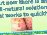 how to treat ringworm in humans - how to get rid of ringworm in humans - treatment for ringworm in humans