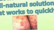 how to treat ringworm in humans - how to get rid of ringworm in humans - treatment for ringworm in humans