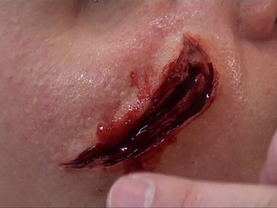 PROTHESE EN GEL DE SILICONE - METAMORPHOSES