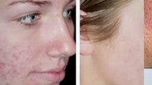 Tips For Getting Rid Of Pimples